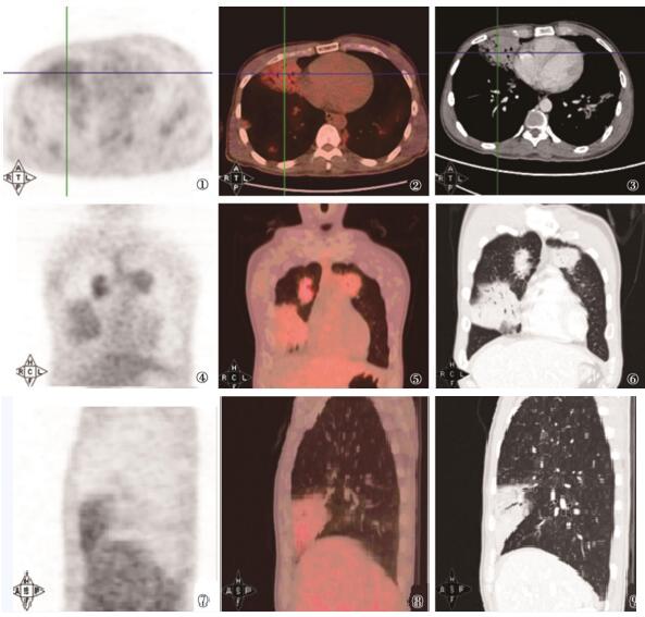 图1 FDG PET/CT胸部横断层图。第一列为PET影像；第二列为同层PET/CT融合影像；第三列为同层CT影像