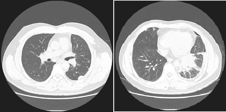 图1 胸部CT：左肺下叶中央型肺癌，双肺及胸膜可见多发结节影，考虑转移癌，左侧液气胸