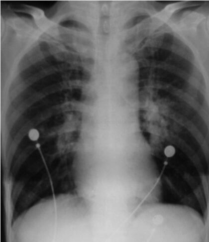 图2胸片（2003‐12‐5，入院前1天）