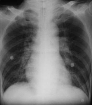 图4胸片（2003‐12‐12，入院第8天）