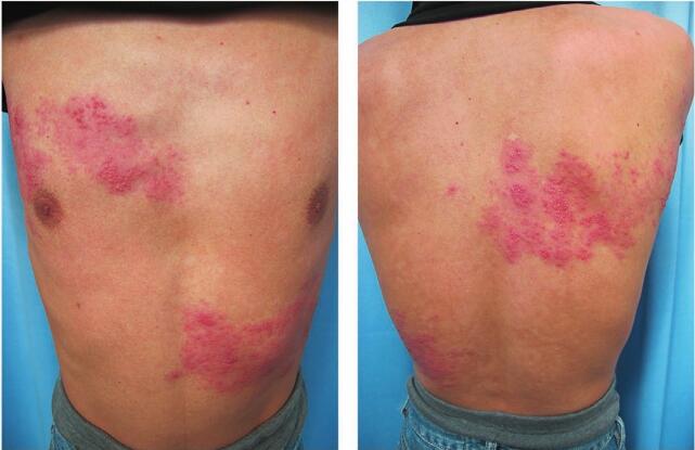 血疱双侧带状疱疹多见于免疫功能低下的人群,如合并多种慢性疾病者