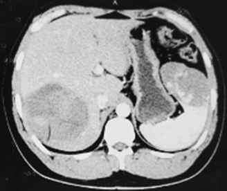图1 上腹部CT（2016年7月7日）.jpg