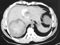 图2 上腹部CT平扫（2016年7月25日）.jpg