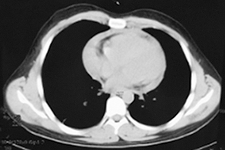 图6 胸腹部CT（2016年8月28日），胸部纵隔窗，提示心包积液.jpg