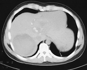 图7 腹部CT（2016年8月28日），提示肝占位.jpg