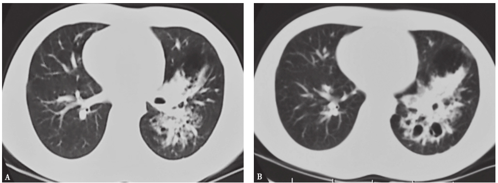 图2 发病第14天胸部CT表现.jpg