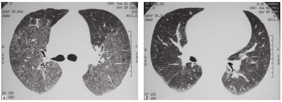 图3 肺-肾出血综合征治疗前后影像改变.jpg