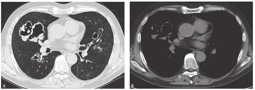 图4 韦格纳肉芽肿胸部CT表现.jpg