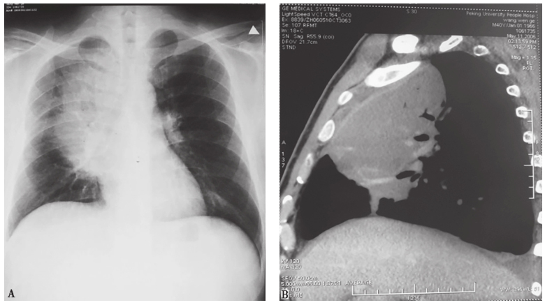 图5 肺淋巴瘤胸部影像学表现.jpg