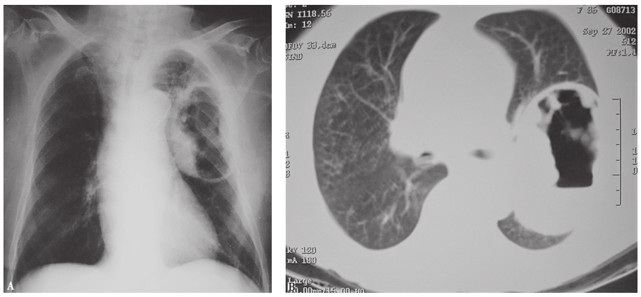 图6 肺鳞癌胸部影像学表现.jpg