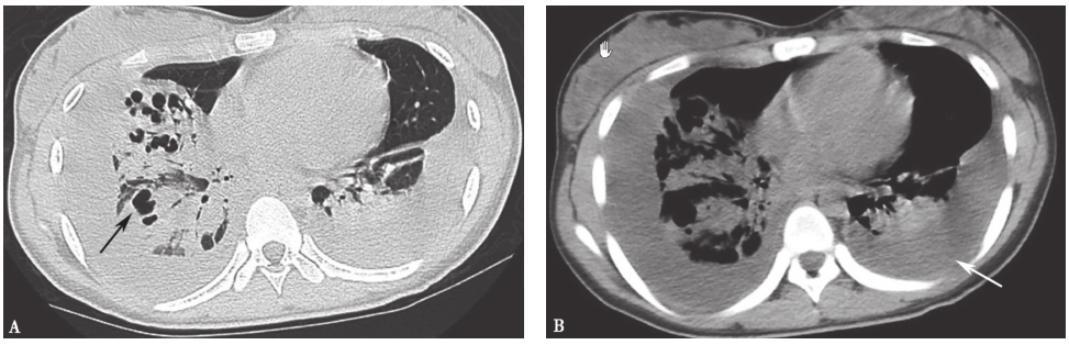 图8 肺脓肿胸部CT表现.jpg