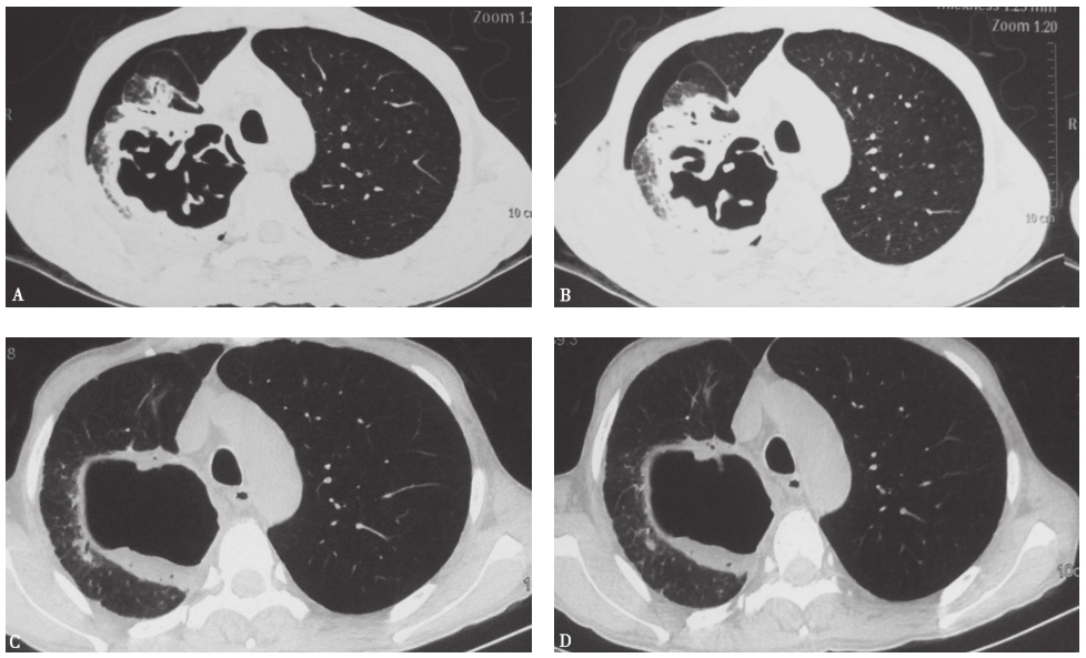 图11 侵袭型肺曲霉菌病胸部CT表现.jpg