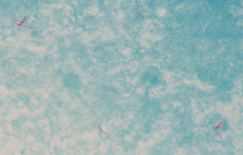 图15 脓液涂片抗酸染色可见抗酸杆菌（抗酸染色，1000×）.jpg