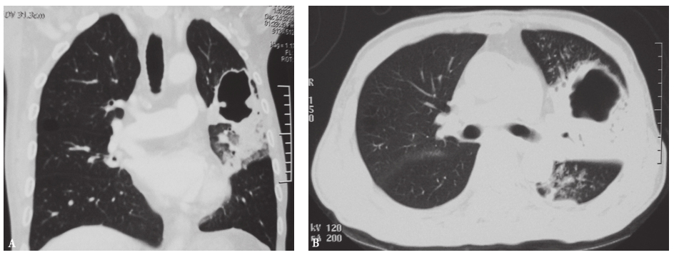 图16 肺结核伴空洞胸部CT表现.jpg