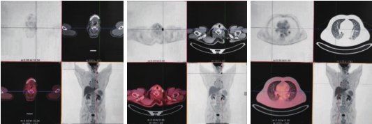 图1 PET-CT（治疗前）
