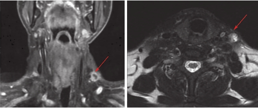 图2 颈部增强MRI（基线）