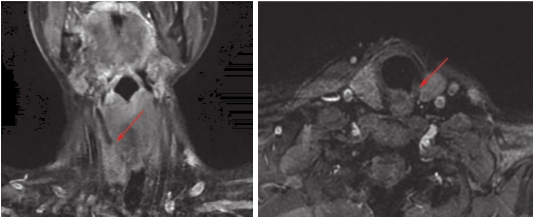 图4 颈部增强MRI：2疗程后达PR