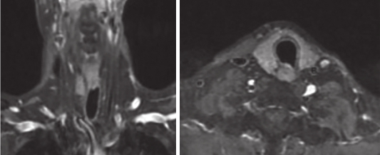 图5 颈部增强MRI：6疗程后靶病灶缩小为不可测量病灶，维持PR