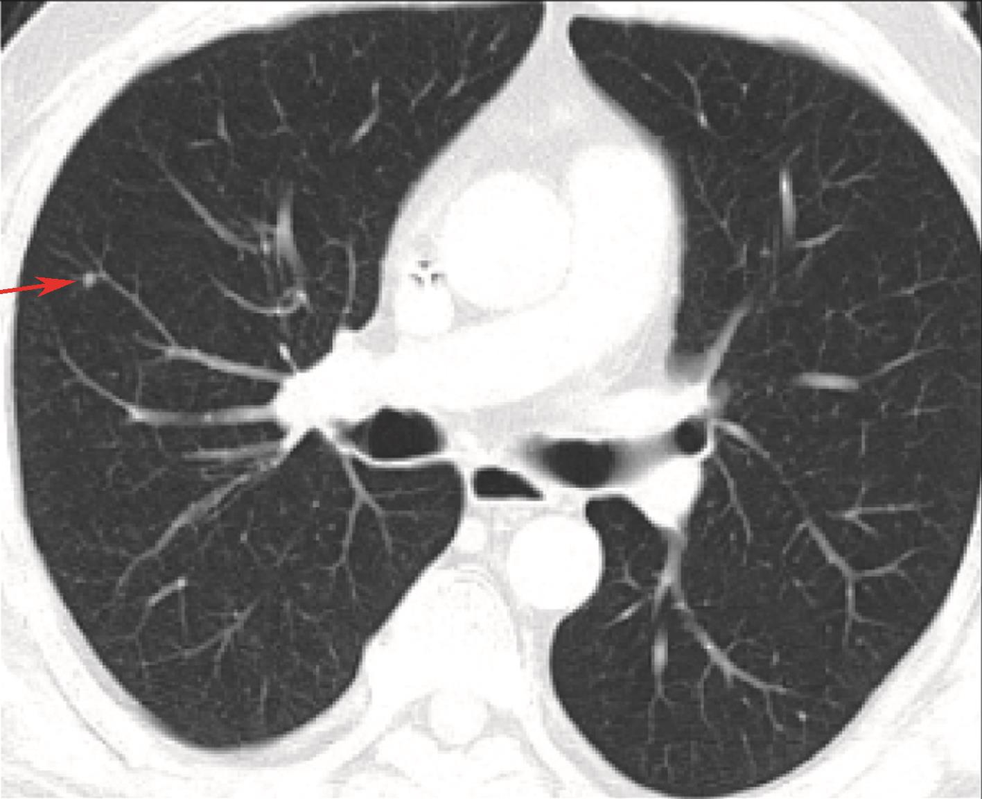 图6 2016-06胸腹盆增强CT，右肺新发小结节-