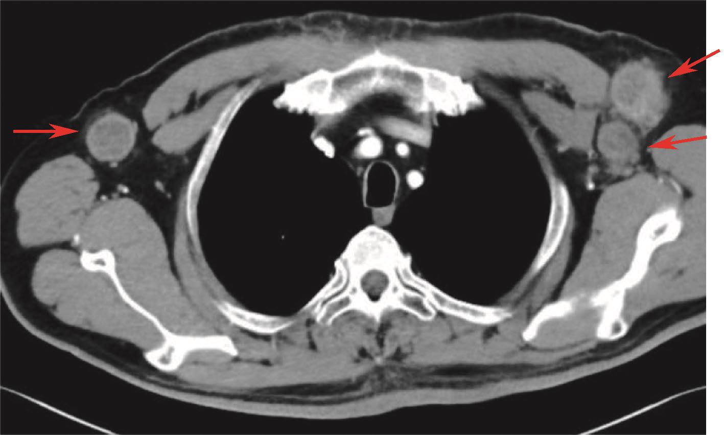 图7 胸腹盆增强CT：提示双侧腋窝多发淋巴结