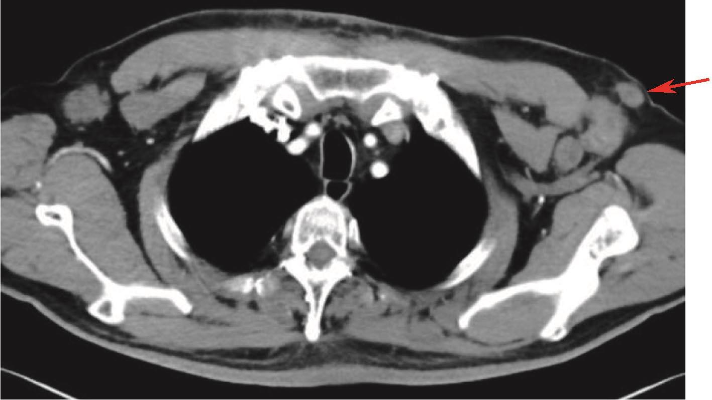 图8 胸腹盆增强CT：左侧腋窝皮下新发小结节