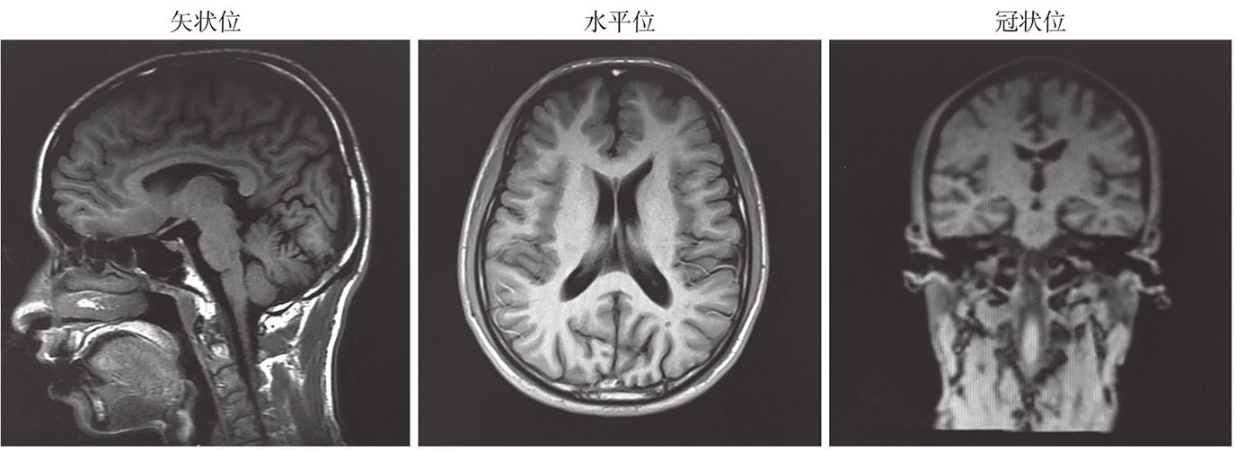 图2 患者头颅磁共振表现