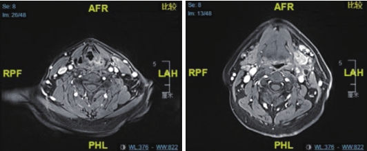 图2（1）喉MRI及腹部MRI（2疗程后）