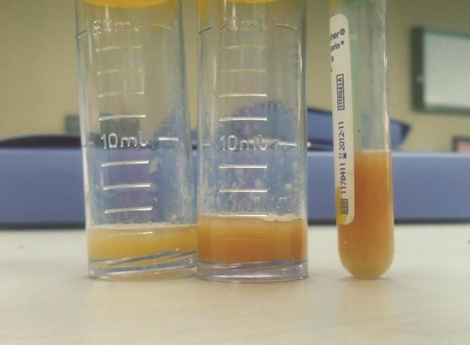 图3 左膝关节腔穿刺液