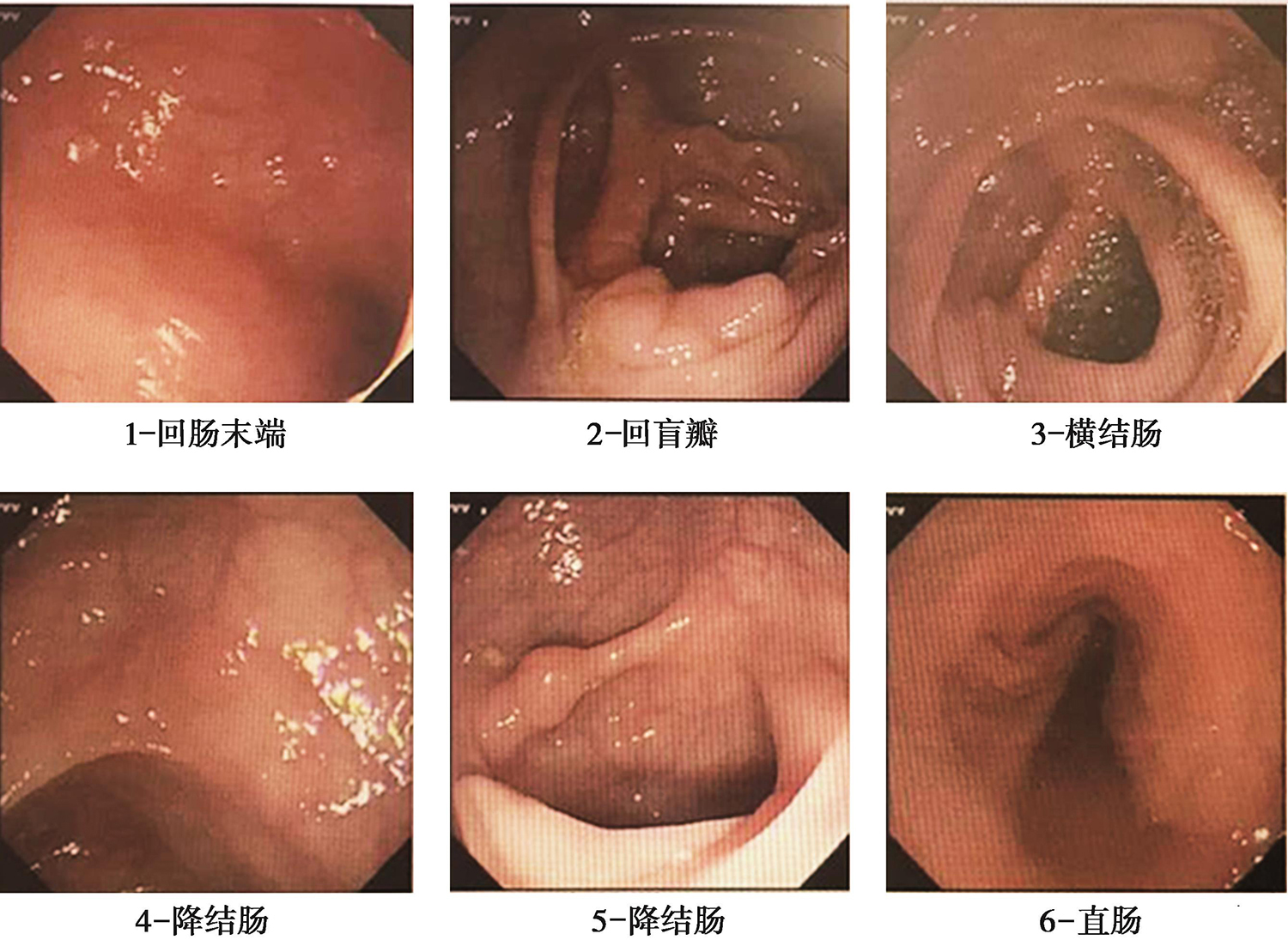 图3 肠镜