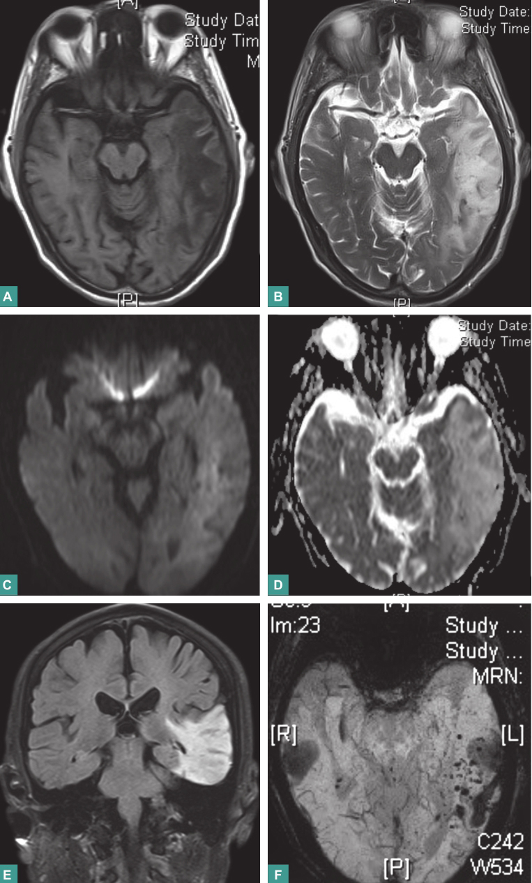图5 栓塞术后复查颅脑MRI