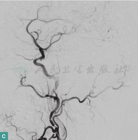 图4 图左侧枕区硬脑膜动静脉瘘血管内栓塞术前、中、后DAS影像-C