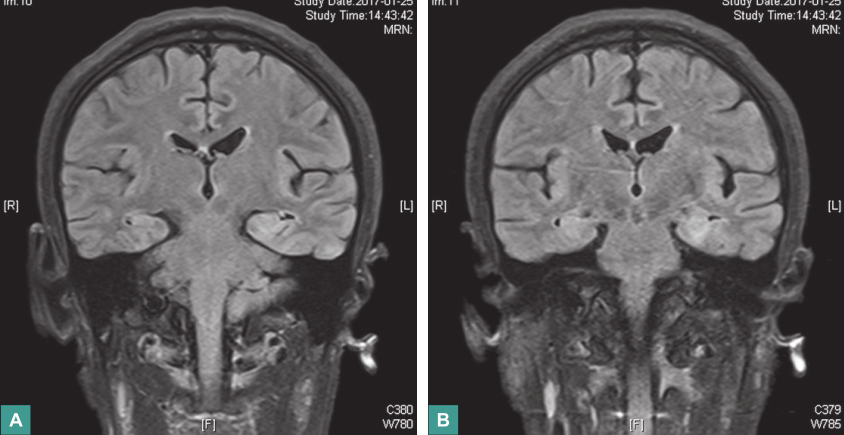 图1 头颅MRI-P222_284_244_1127_677_177486