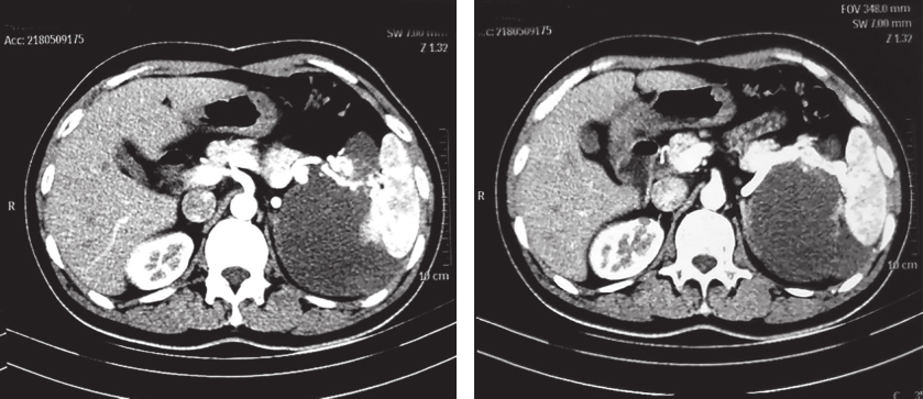 图2 2018年5月9日增强CT