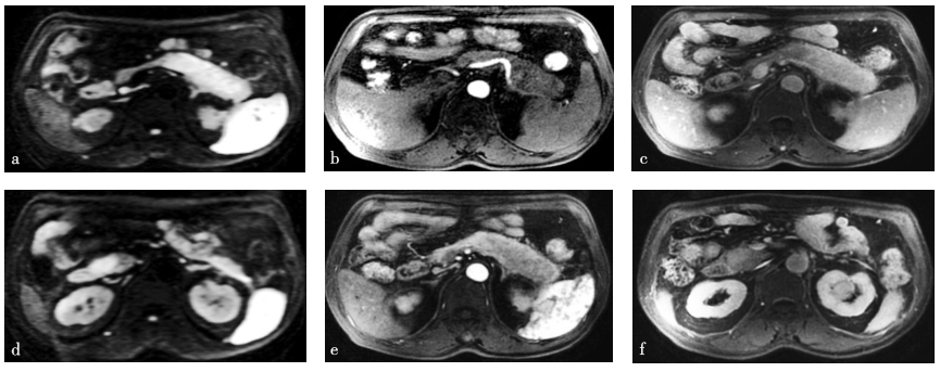 图1 磁共振成像［弥散加权成像技术（diffusion weighted imaging，DWI）、增强早期+晚期、门脉期］