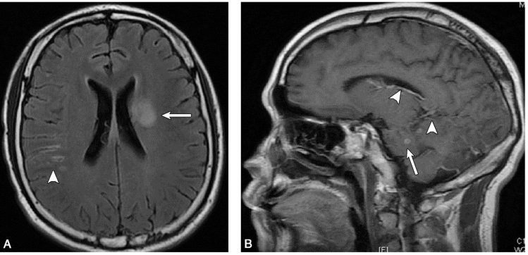 图4 头颅MRI：左侧基底节区及左颞叶异常信号灶（白箭）；软脑膜多发强化（白箭头）