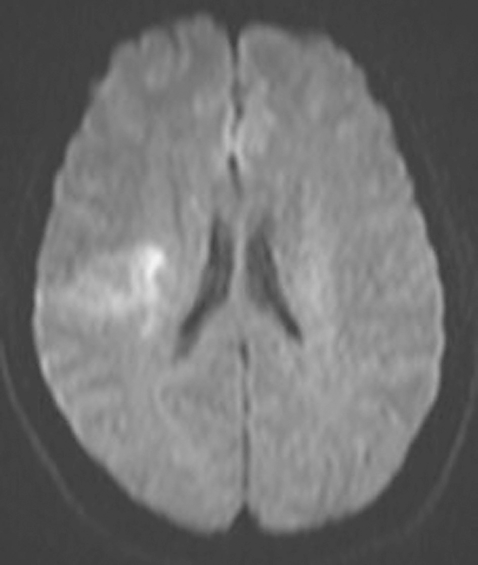 图4 发病后12天颅脑MRI DWI像