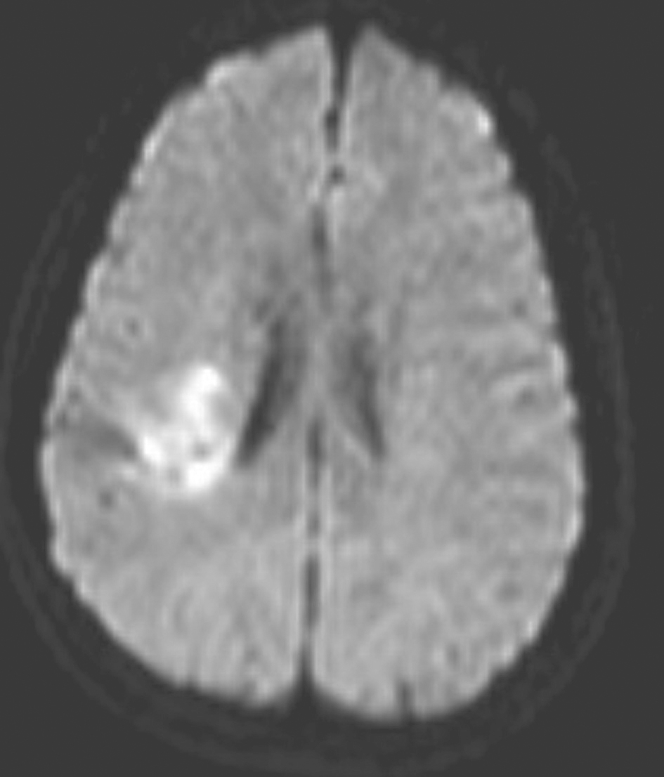 图3 发病后2个月余颅脑MRI DWI像