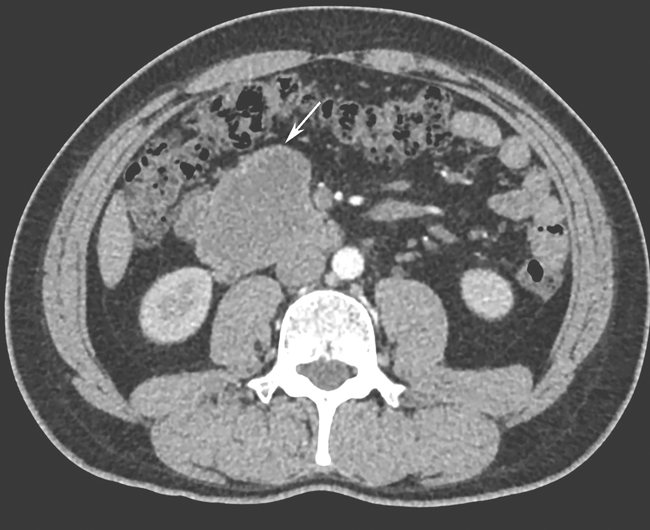 图2 2018年3月全腹增强CT