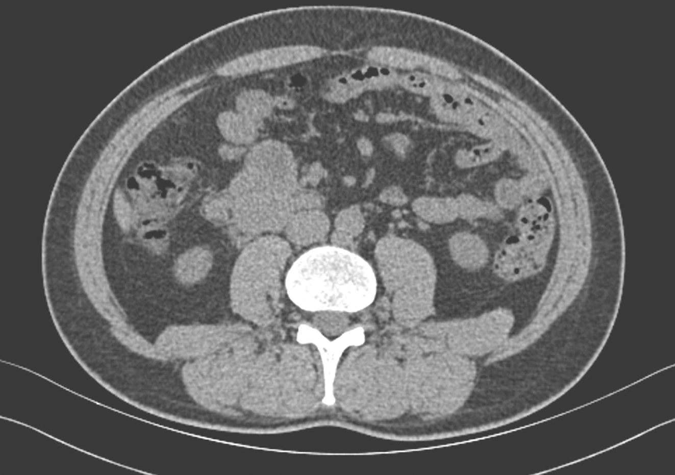 图3 2018年6月全腹增强CT