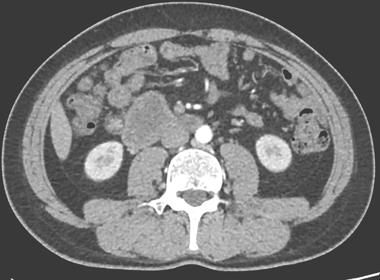 图4 2018年9月全腹增强CT
