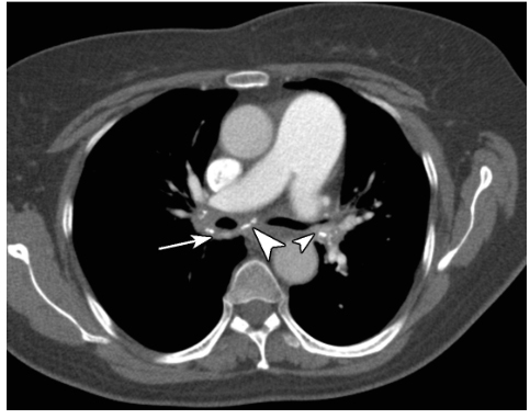/uploads/image/2025-04-11/104356686图1 慢性纵隔炎.jpg 图1 慢性纵隔炎