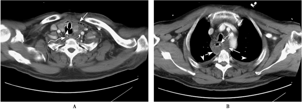 /uploads/image/2025-04-11/104418223图2 纵隔脓肿.jpg 图2 纵隔脓肿