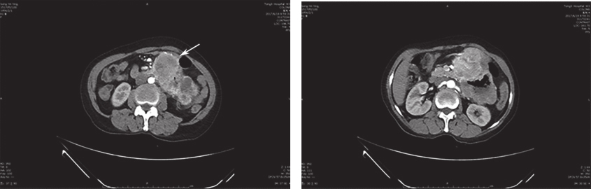 图1 腹部增强CT