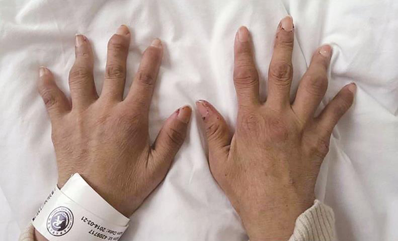 图1 患者双手关节畸形