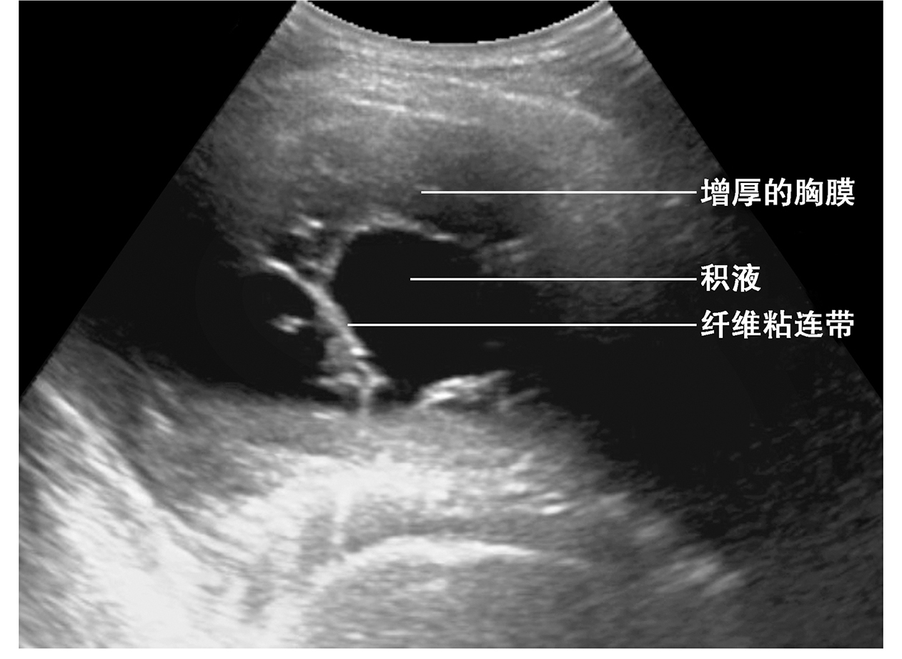 图6 肺炎患者的胸腔包裹性积液