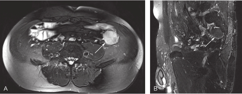 图1 腹部MRI