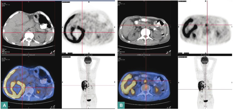 图52015年9月6日全身PET-CT