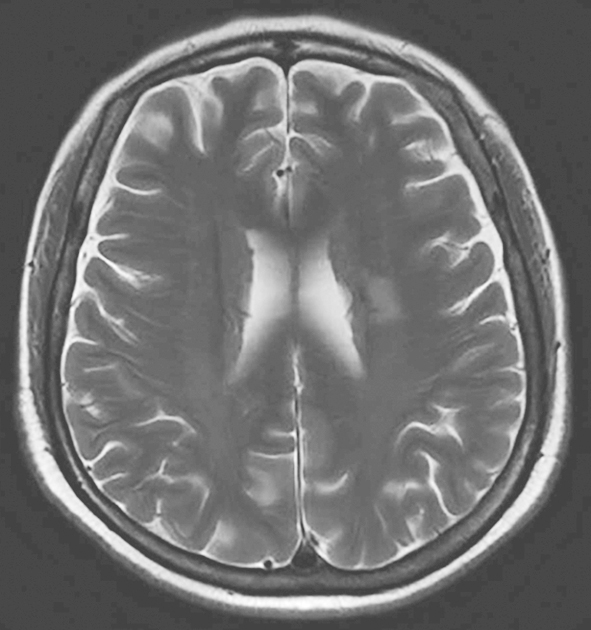 图1颅脑MRI