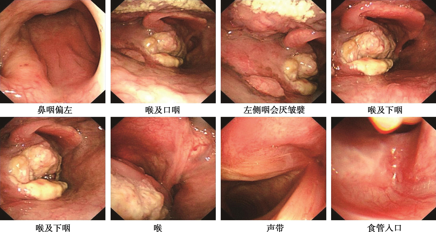 图1左梨状窝可见菜花样肿物、环后区和下咽后壁偏左侧受累及