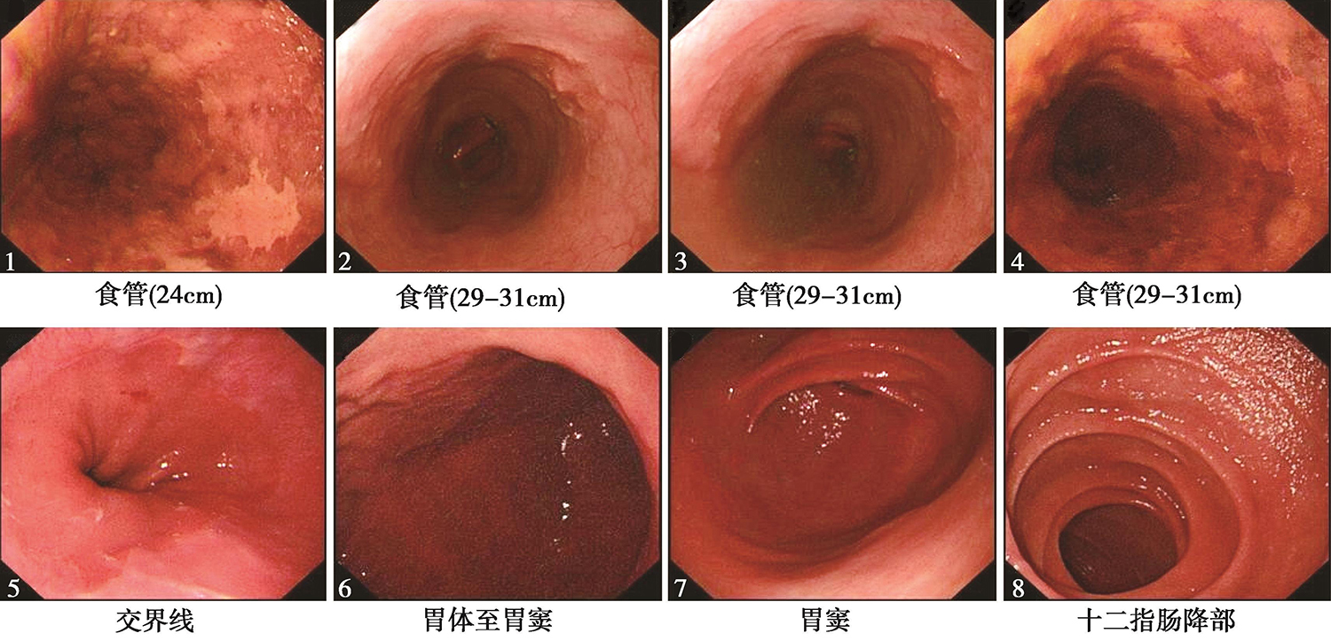 图2食管浅表隆起+浅表凹陷性病变、考虑为早期食管癌